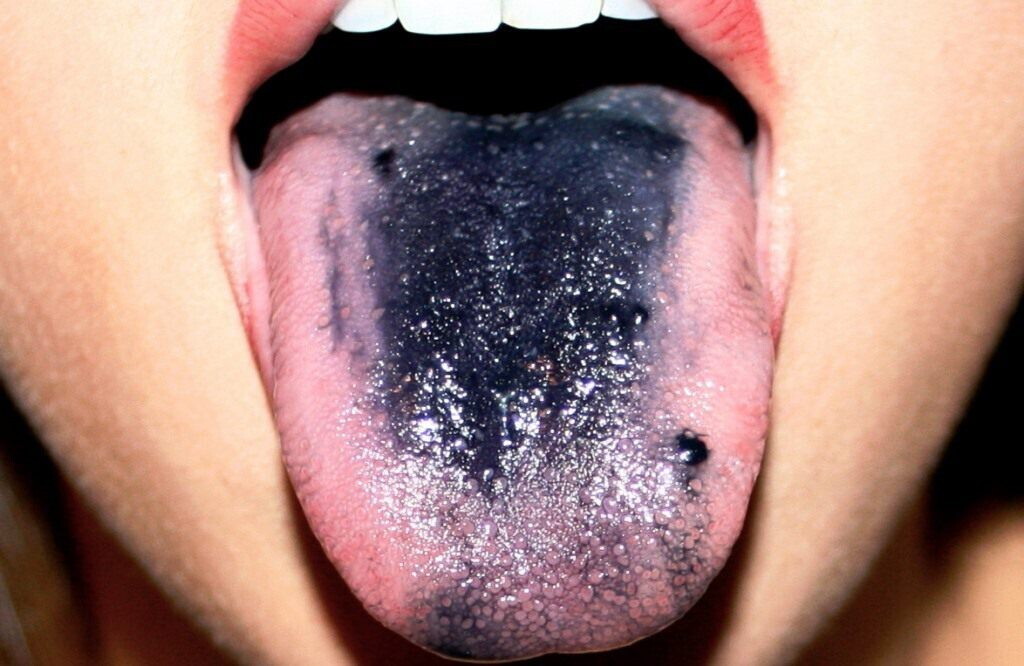 Черный налет на языке: причины, лечение Черный налет на языке: причины, лечение