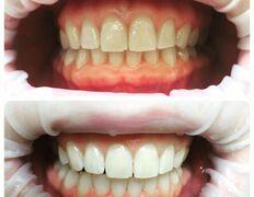 Стоматологія Чібіс, Примеры работ  - фото 8