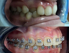 Стоматология Hiuldana Dental Clinic (Гюльдана Дентал Клиник, Гюльдана Дентал Клінік), Наши работы - фото 5