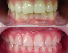 Стоматология Hiuldana Dental Clinic (Гюльдана Дентал Клиник, Гюльдана Дентал Клінік), Наши работы - фото 6