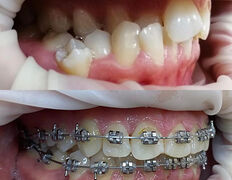 Стоматология Hiuldana Dental Clinic (Гюльдана Дентал Клиник, Гюльдана Дентал Клінік), Наши работы - фото 7