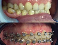 Стоматология Hiuldana Dental Clinic (Гюльдана Дентал Клиник, Гюльдана Дентал Клінік), Наши работы - фото 3
