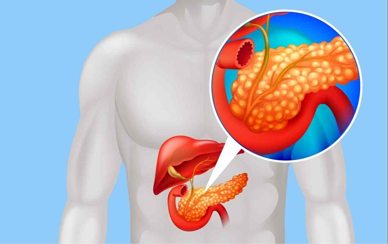 Как лечат патологию поджелудочной железы?