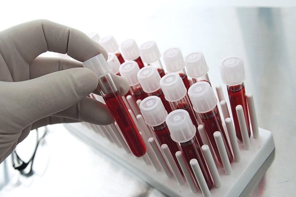 О чем говорит понижение эозинофилов у взрослых О чем говорит понижение эозинофилов у взрослых