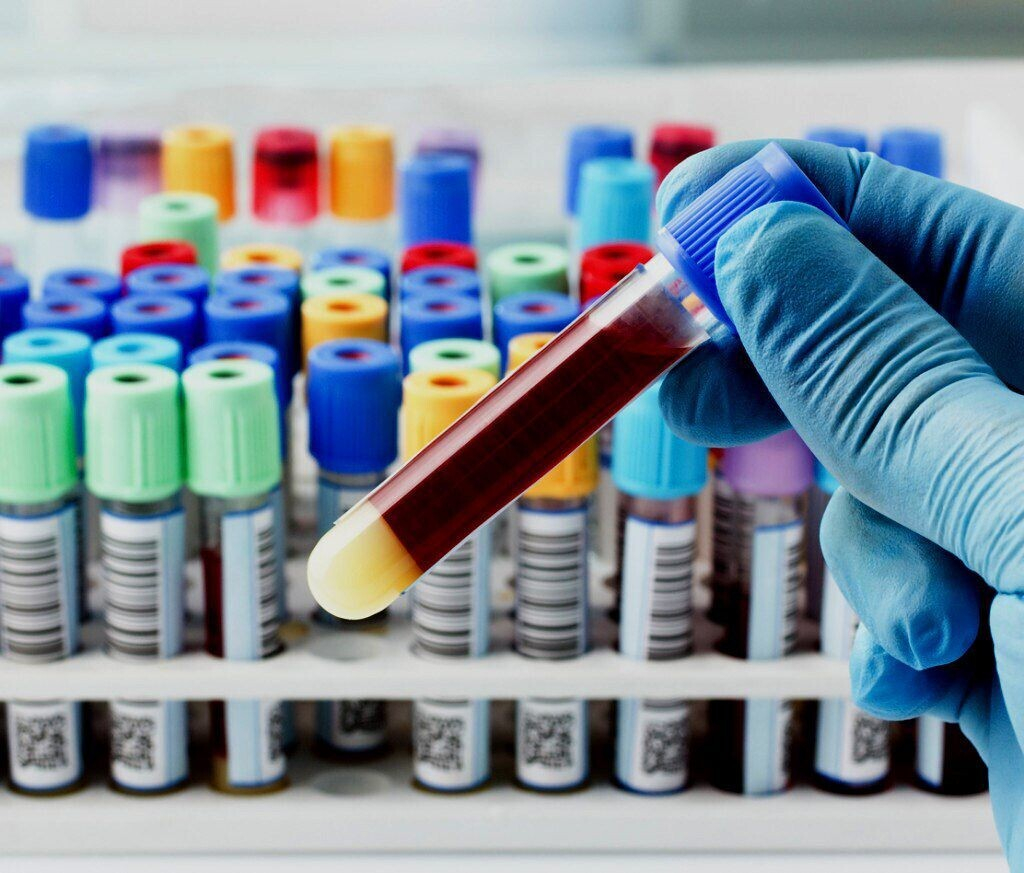 Норма холестерина в крови у женщин: таблица по возрасту Норма холестерина в крови у женщин: таблица по возрасту