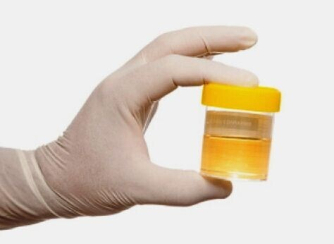 О чем говорит повышение сахара в моче О чем говорит повышение сахара в моче