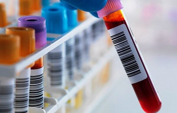 Норма СОЭ в крови у мужчин по возрасту