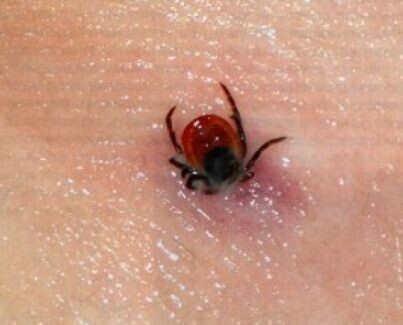 Симптомы укуса клеща